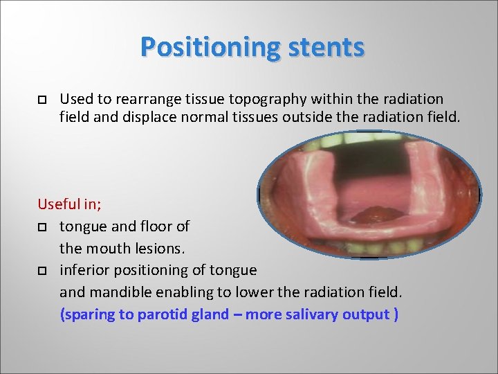 Positioning stents Used to rearrange tissue topography within the radiation field and displace normal Positioning stents Used to rearrange tissue topography within the radiation field and displace normal