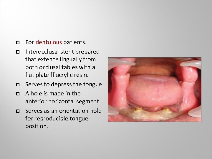 For dentulous patients. Interocclusal stent prepared that extends lingually from both occlusal tables For dentulous patients. Interocclusal stent prepared that extends lingually from both occlusal tables