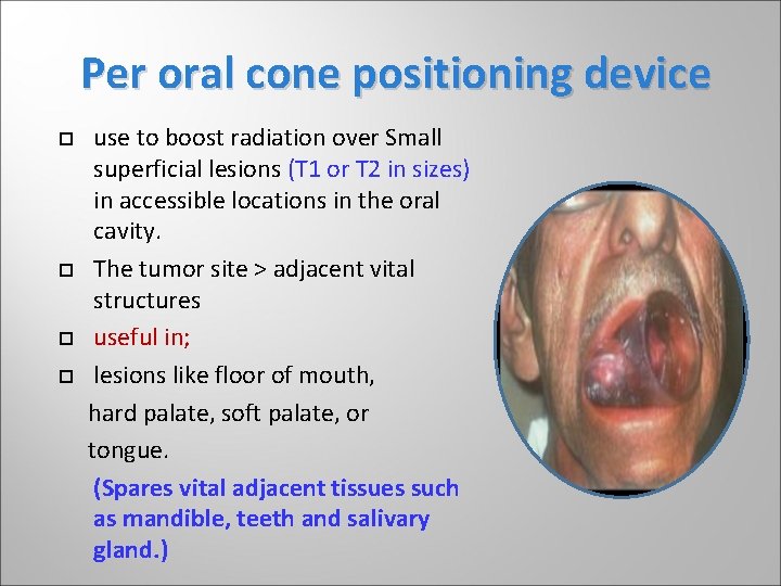 Per oral cone positioning device use to boost radiation over Small superficial lesions (T Per oral cone positioning device use to boost radiation over Small superficial lesions (T