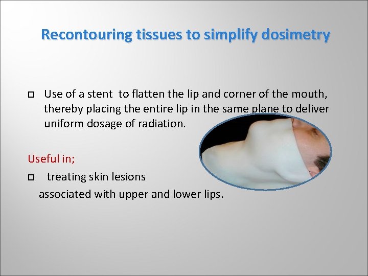 Recontouring tissues to simplify dosimetry Use of a stent to flatten the lip and Recontouring tissues to simplify dosimetry Use of a stent to flatten the lip and