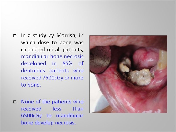 In a study by Morrish, in which dose to bone was calculated on In a study by Morrish, in which dose to bone was calculated on