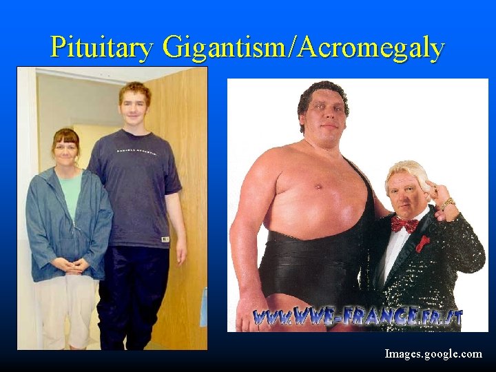 Pituitary Gigantism/Acromegaly Images. google. com 