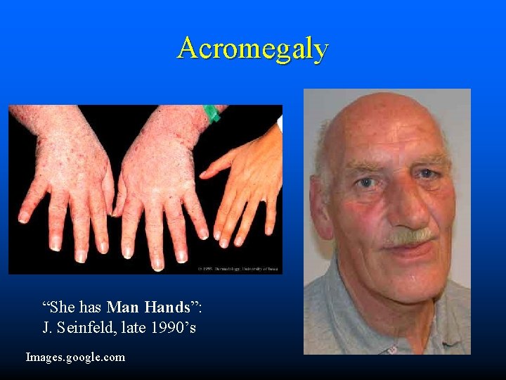 Acromegaly “She has Man Hands”: J. Seinfeld, late 1990’s Images. google. com 