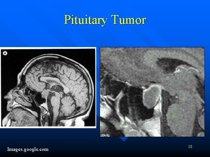 Pituitary Tumor Images. google. com 18 