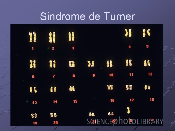 Sindrome de Turner 