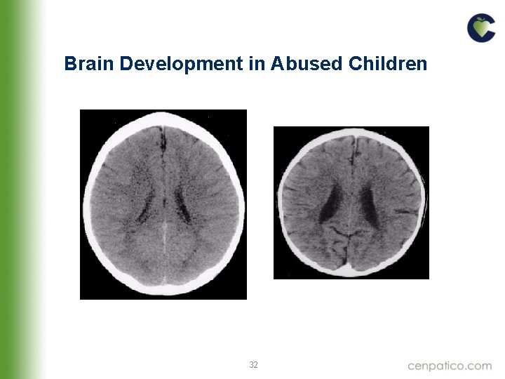Brain Development in Abused Children 32 Brain Development in Abused Children 32