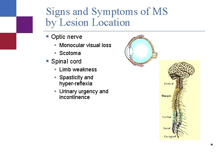 Signs and Symptoms of MS by Lesion Location § Optic nerve § Monocular visual