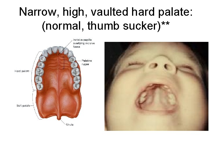 Narrow, high, vaulted hard palate: (normal, thumb sucker)** 