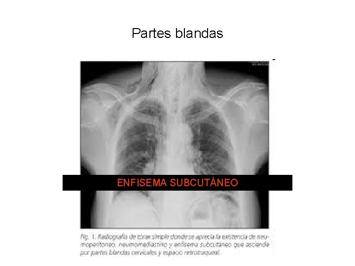 Partes blandas ENFISEMA SUBCUTÁNEO 