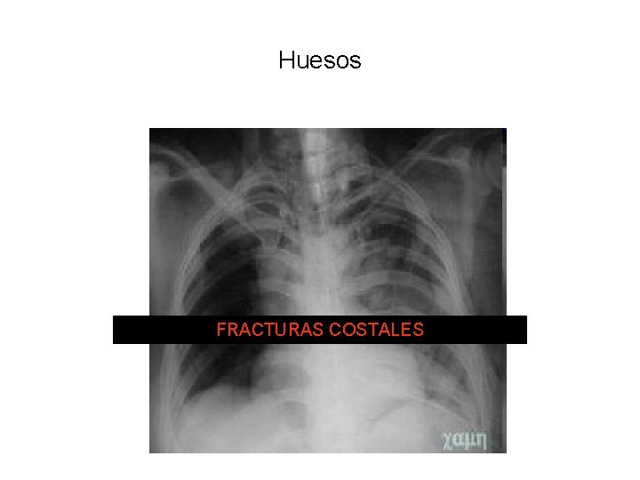 Huesos FRACTURAS COSTALES 