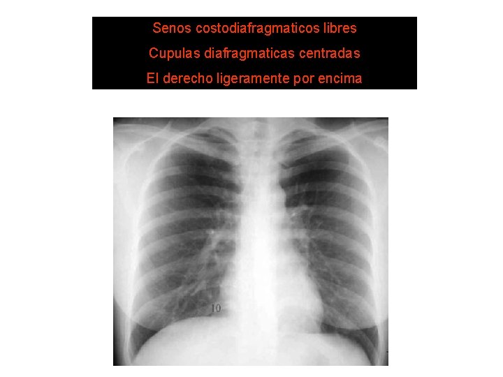 Senos costodiafragmaticos libres SISTEMA DE LECTURA 3. diafragmaticas Diafragma Cupulas centradas El derecho ligeramente