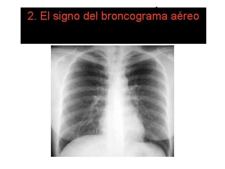 LOS RADIOLÓGICOS 2. El SIGNOS signo del broncograma aéreo FUNDAMENTALES 