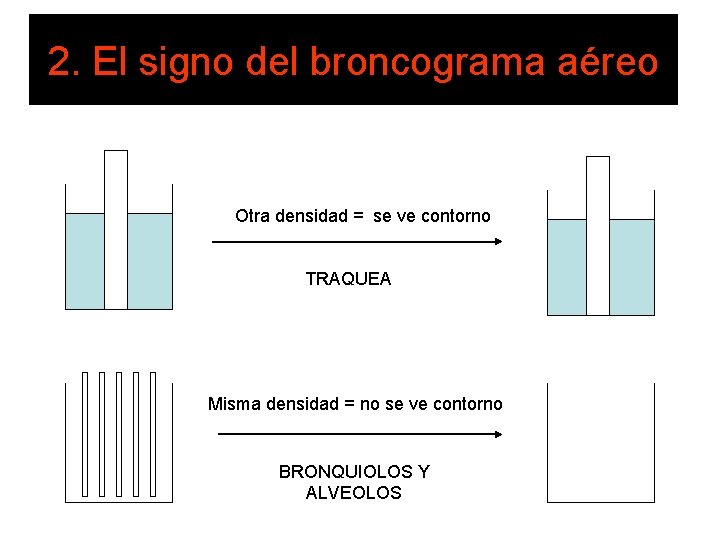 2. El signo del broncograma aéreo Otra densidad = se ve contorno TRAQUEA Misma