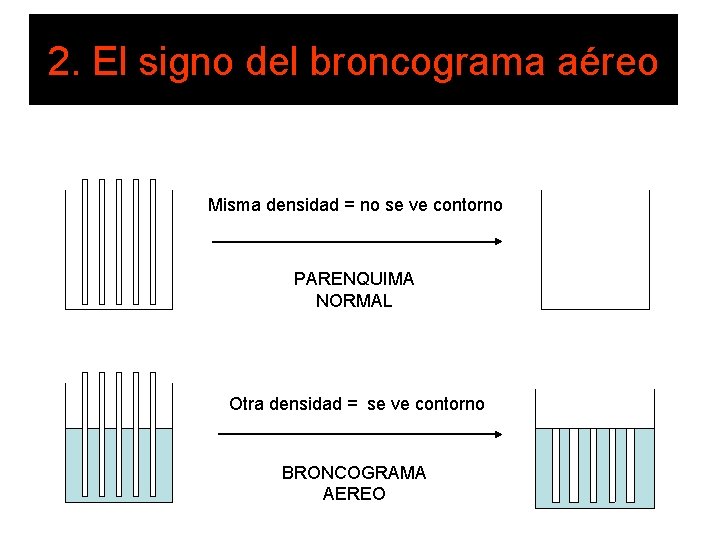 2. El signo del broncograma aéreo Misma densidad = no se ve contorno PARENQUIMA