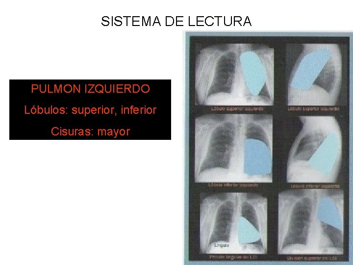 SISTEMA DE LECTURA PULMON IZQUIERDO Lóbulos: superior, inferior Cisuras: mayor 