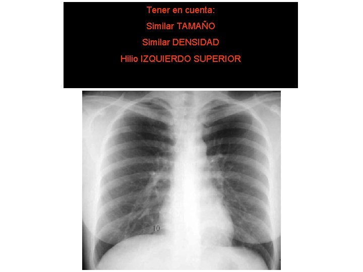 Tener en cuenta: Similar TAMAÑO SISTEMA DE LECTURA 5. Hilios pulmonares Similar DENSIDAD Hilio