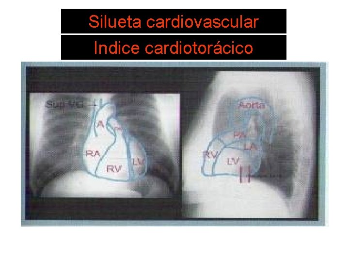 SISTEMA DE LECTURA 6. Silueta Estructuras cardiovasculares Indice cardiotorácico 