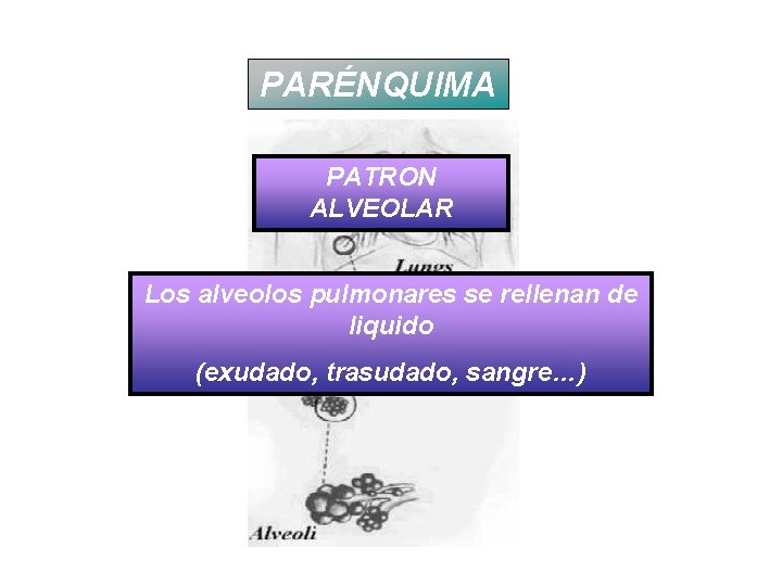 PARÉNQUIMA PATRON ALVEOLAR Los alveolos pulmonares se rellenan de liquido (exudado, trasudado, sangre…) 