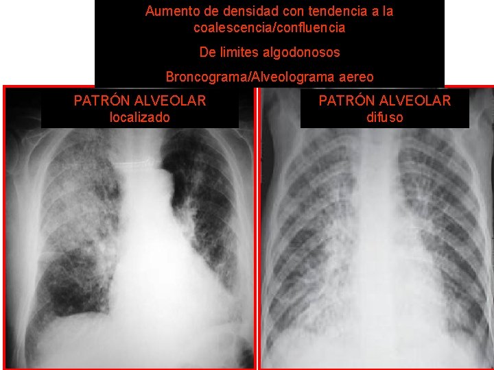 Aumento de densidad con tendencia a la PATRON coalescencia/confluencia ALVEOLAR De limites algodonosos Broncograma/Alveolograma