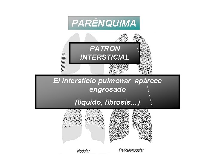 PARÉNQUIMA PATRON INTERSTICIAL El intersticio pulmonar aparece engrosado (liquido, fibrosis…) 