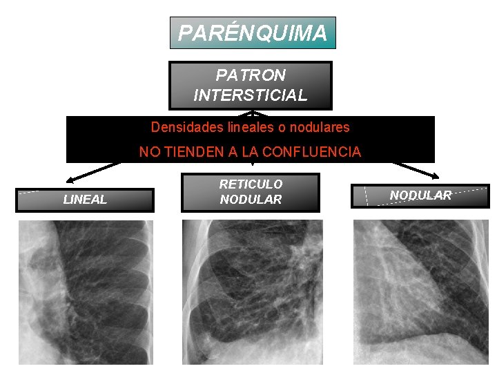 PARÉNQUIMA PATRON INTERSTICIAL Densidades lineales o nodulares NO TIENDEN A LA CONFLUENCIA LINEAL RETICULO