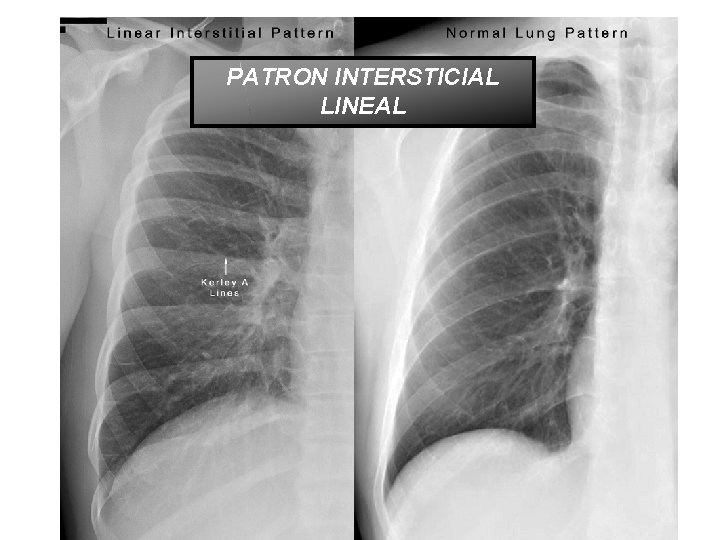 PATRON INTERSTICIAL LINEAL 