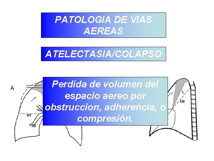 PATOLOGIA DE VIAS AEREAS ATELECTASIA/COLAPSO Perdida de volumen del espacio aereo por obstruccion, adherencia,