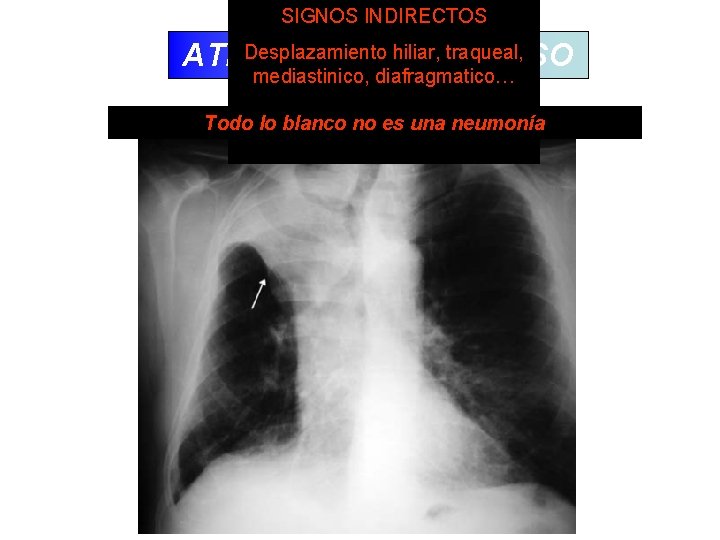 SIGNOSINDIRECTOS Desplazamiento hiliar, cisural traqueal, ATELECTASIA/COLAPSO mediastinico, diafragmatico… Agrupamiento broncovascular Todo lo blanco no