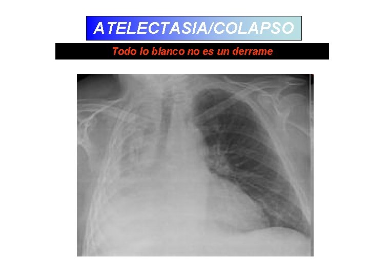 ATELECTASIA/COLAPSO Todo lo blanco no es un derrame 