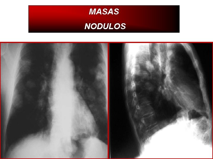 MASAS NODULOS 