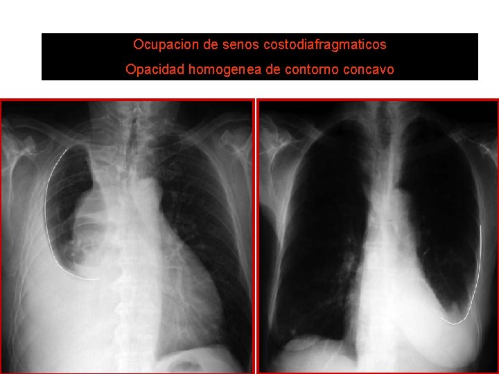 Ocupacion de senos costodiafragmaticos DERRAME PLEURAL Opacidad homogenea de contorno concavo 