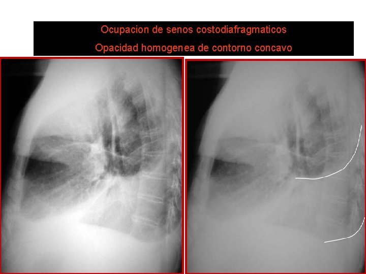 Ocupacion de senos costodiafragmaticos DERRAME PLEURAL Opacidad homogenea de contorno concavo 
