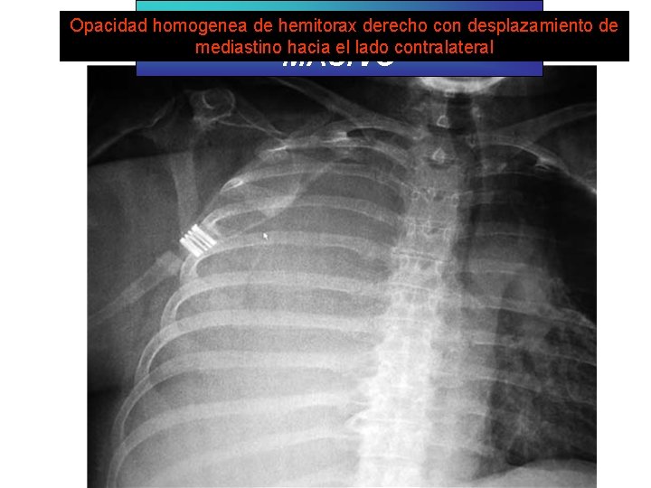 DERRAME PLEURAL MASIVO Opacidad homogenea de hemitorax derecho con desplazamiento de mediastino hacia el