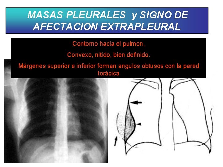 MASAS PLEURALES y SIGNO DE AFECTACION EXTRAPLEURAL Contorno hacia el pulmon, Convexo, nitido, bien