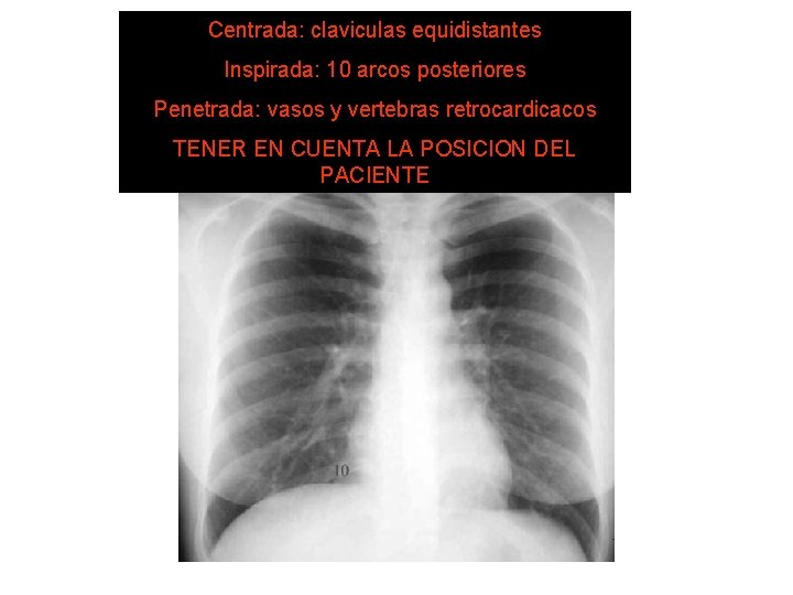 Centrada: claviculas equidistantes Inspirada: 10 arcos posteriores ¿ ESTÁ BIEN SISTEMA DE HECHA LECTURA?