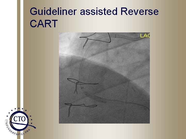 Guideliner assisted Reverse CART 