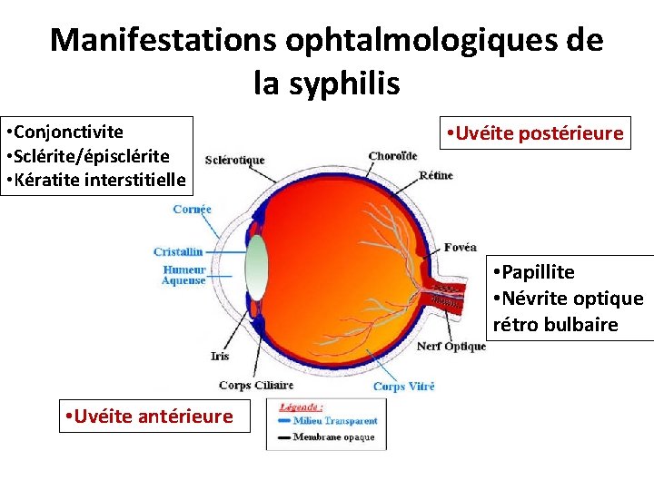 Manifestations ophtalmologiques de la syphilis • Conjonctivite • Sclérite/épisclérite • Kératite interstitielle • Uvéite