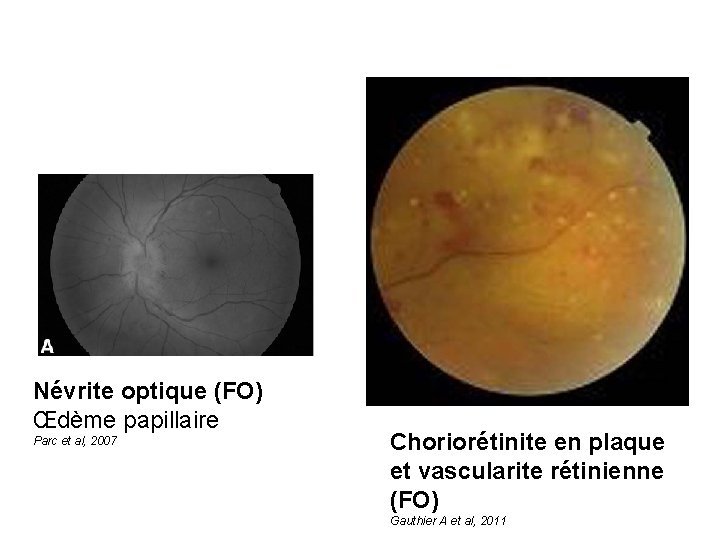 Névrite optique (FO) Œdème papillaire Parc et al, 2007 Choriorétinite en plaque et vascularite