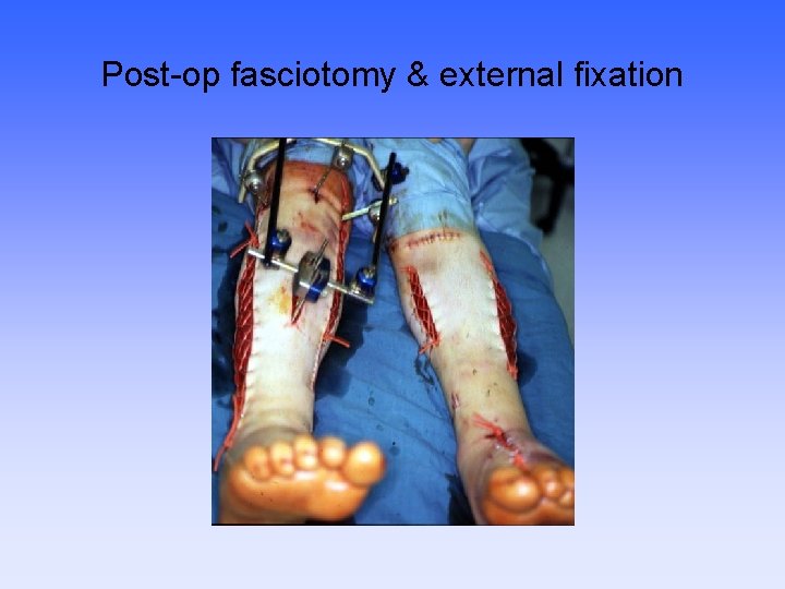 Post-op fasciotomy & external fixation 