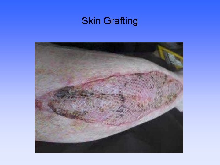 Skin Grafting 