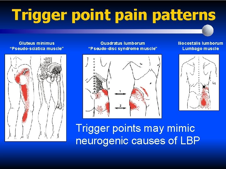 Trigger point pain patterns Gluteus minimus “Pseudo-sciatica muscle” Quadratus lumborum “Pseudo-disc syndrome muscle” Iliocostalis