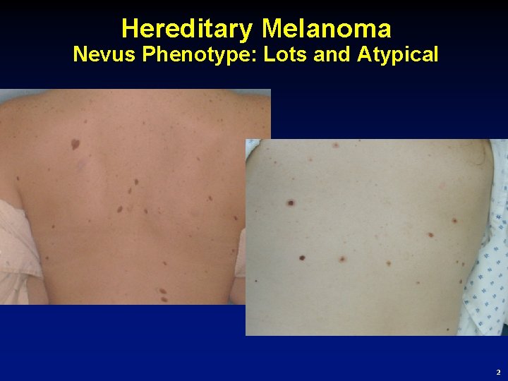 Hereditary Melanoma Nevus Phenotype: Lots and Atypical 2 