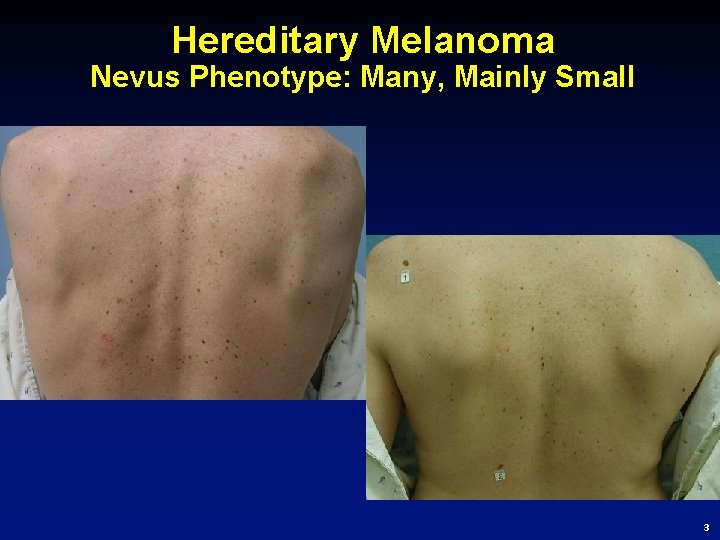 Hereditary Melanoma Nevus Phenotype: Many, Mainly Small 3 