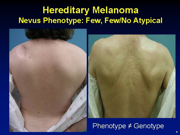 Hereditary Melanoma Nevus Phenotype: Few, Few/No Atypical Phenotype ≠ Genotype 4 