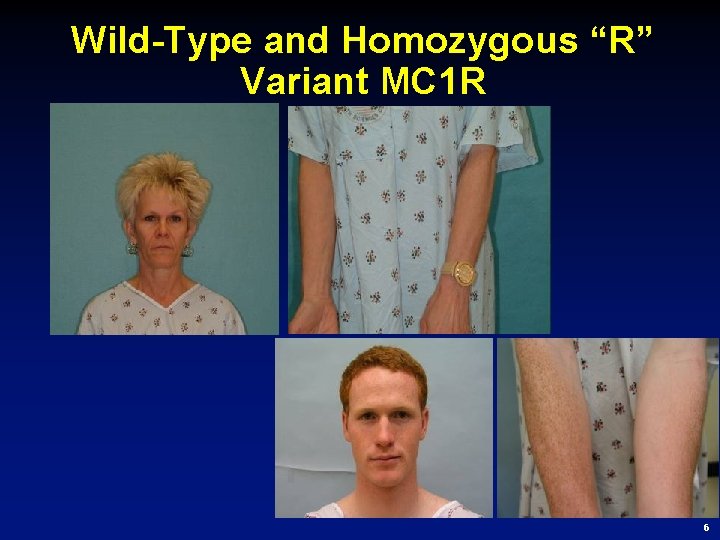 Wild-Type and Homozygous “R” Variant MC 1 R 6 