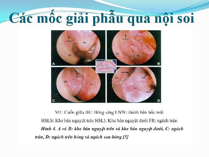 Các mốc giải phẫu qua nội soi 