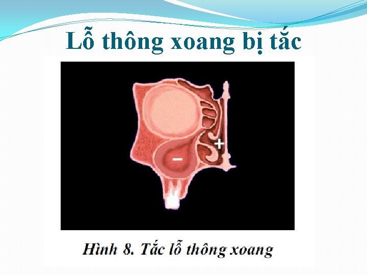 Lỗ thông xoang bị tắc 