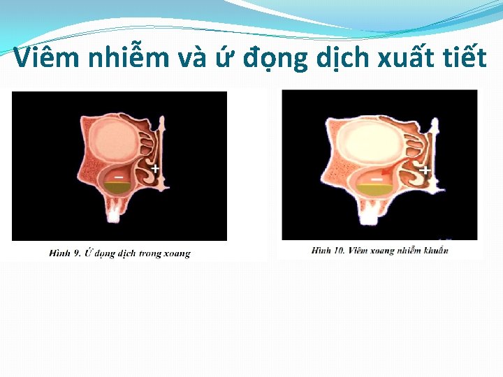 Viêm nhiễm và ứ đọng dịch xuất tiết 