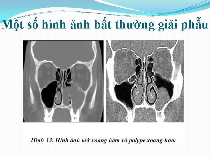 Một số hình ảnh bất thường giải phẫu 