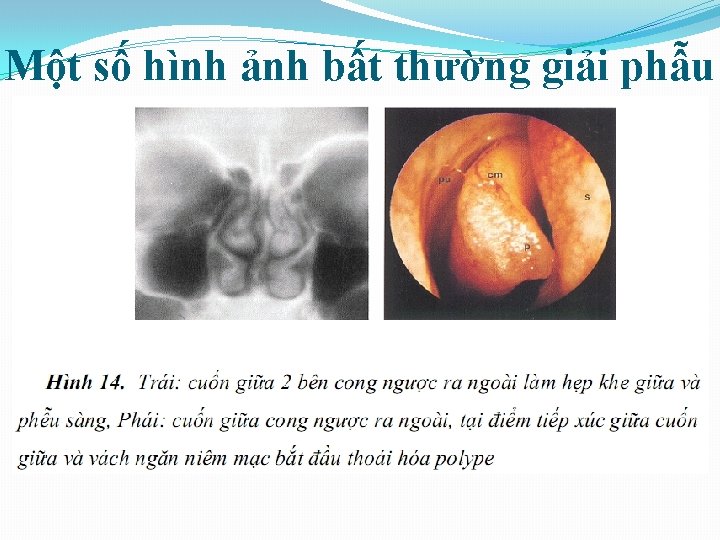 Một số hình ảnh bất thường giải phẫu 